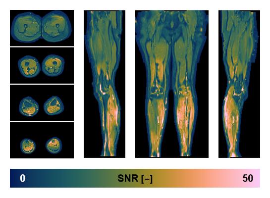 SNR distribution of the unweighted diffusion data.