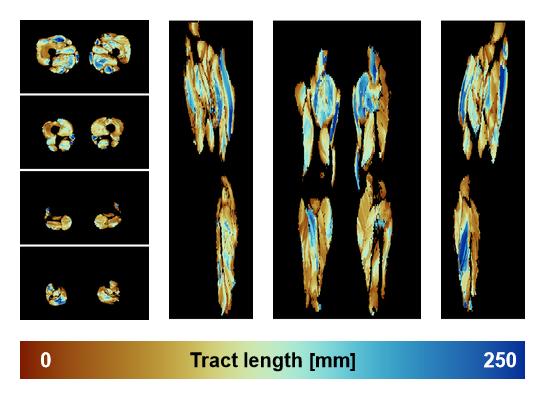 Muscle fiber tract length map based on whole leg DTI based fiber tractography.