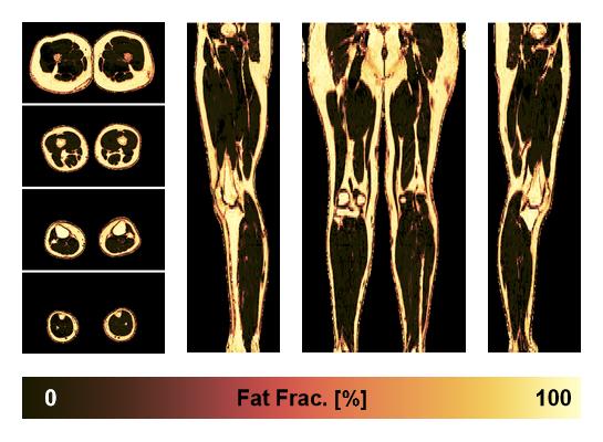 The fat fraction of the lower extremity obtained from the dixon reconstruction for muscle water fat quantification.