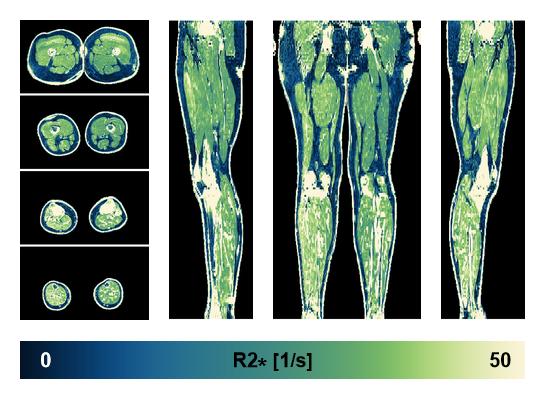 The R2 star relaxation time of the lower extremity obtained from the dixon reconstruction for muscle water fat quantification.