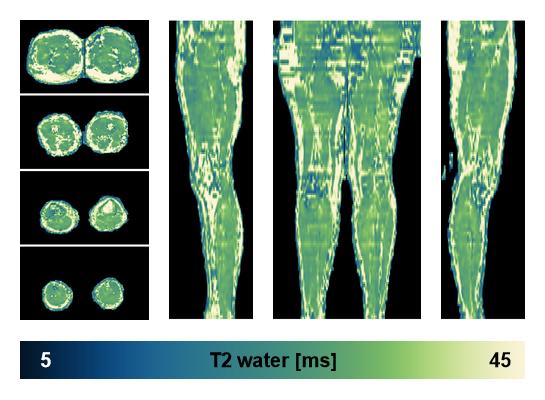 The water only T2 relaxation time of the lower extremity obtained from multi echo spin echo t2 mapping with EPG based reconstruction.