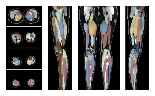 Overlay of automated muscle segmentation labels on dixon water image.