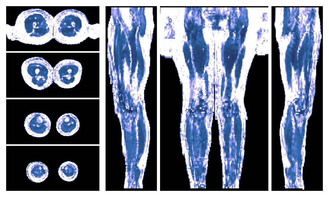 IVIM corrected whole leg muscle fractional anisotropy obtained from diffusion tensor imaging.