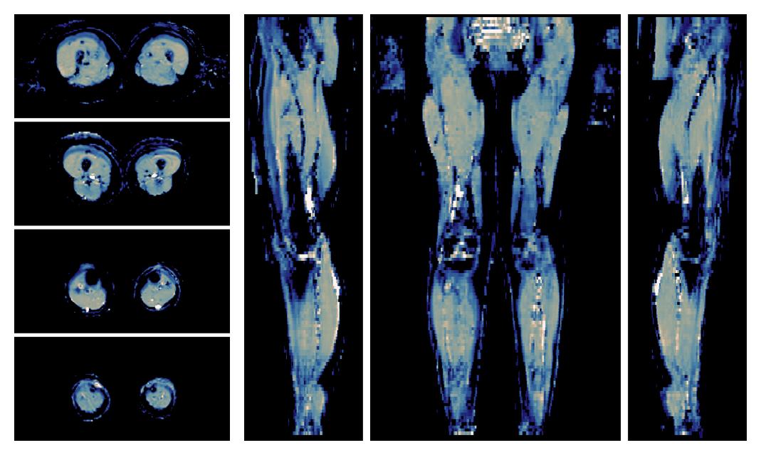 IVIM corrected whole leg muscle mean diffusivity obtained from diffusion tensor imaging.