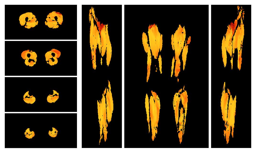 Muscle fiber tract angle map based on whole leg DTI based fiber tractography.