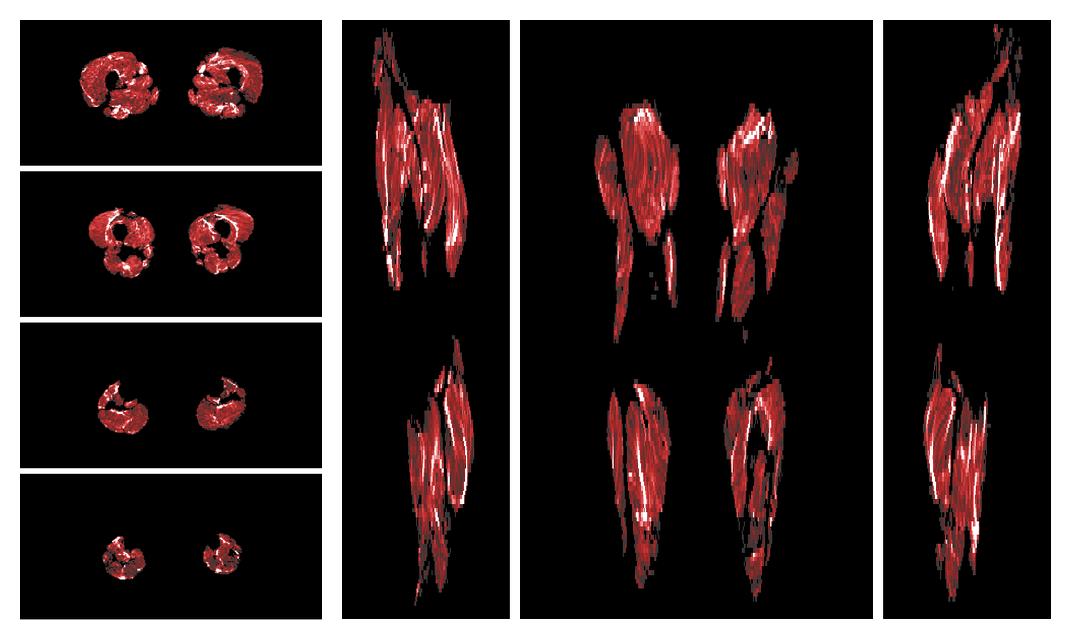 Muscle fiber tract density map based on whole leg DTI based fiber tractography.