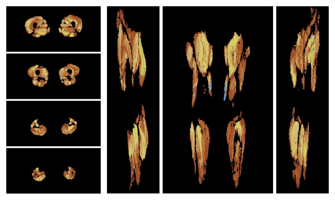 Muscle fiber tract length map based on whole leg DTI based fiber tractography.