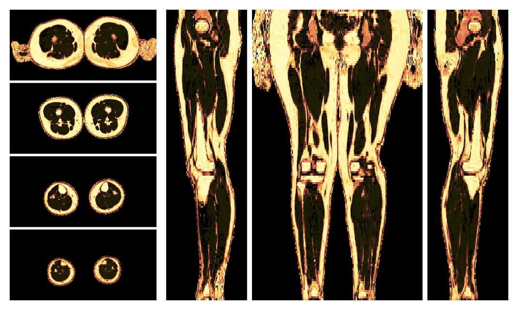 The fat fraction of the lower extremity obtained from the dixon reconstruction for muscle water fat quantification.