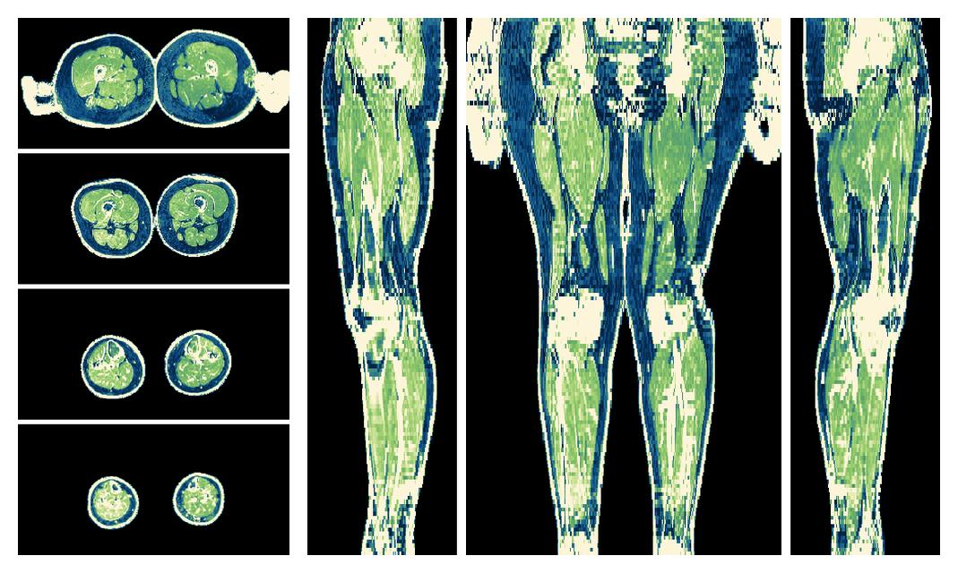 The R2 star relaxation time of the lower extremity obtained from the dixon reconstruction for muscle water fat quantification.