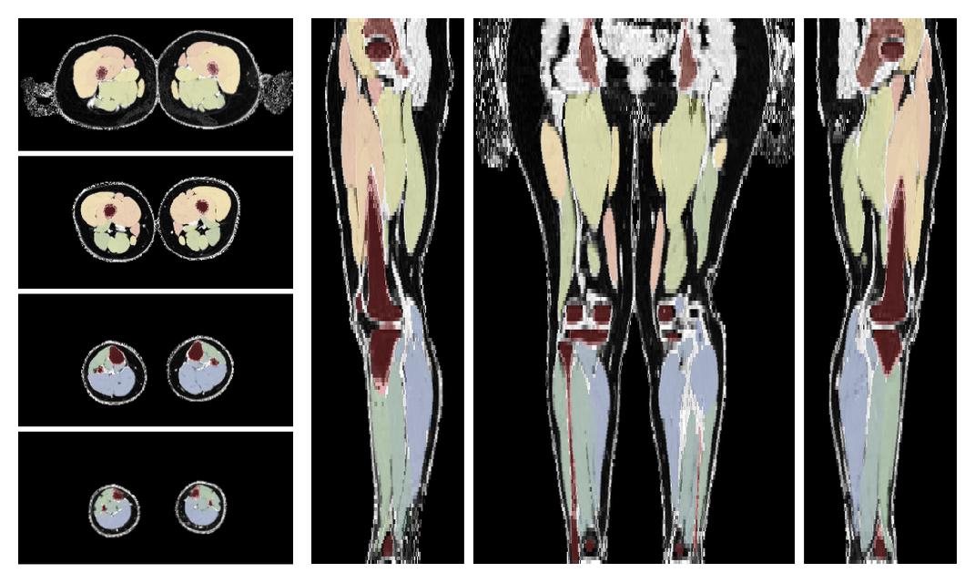 Overlay of automated muscle segmentation labels on dixon water image.