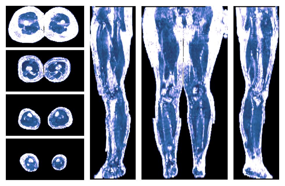 IVIM corrected whole leg muscle fractional anisotropy obtained from diffusion tensor imaging.