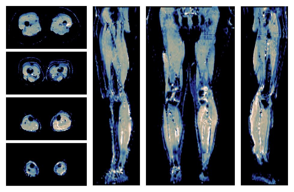 IVIM corrected whole leg muscle mean diffusivity obtained from diffusion tensor imaging.