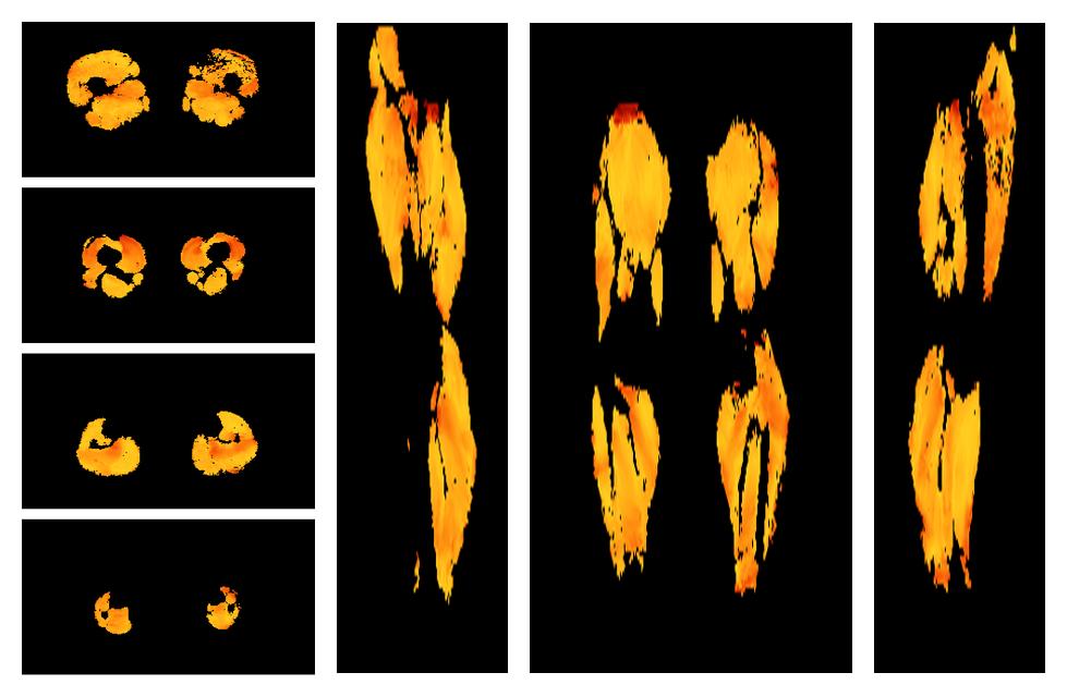 Muscle fiber tract angle map based on whole leg DTI based fiber tractography.