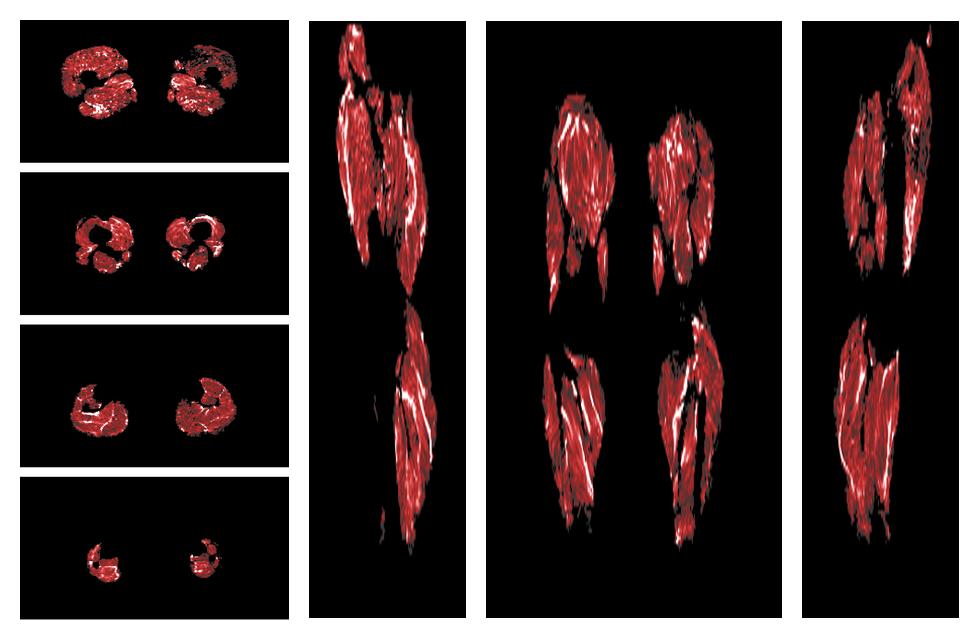 Muscle fiber tract density map based on whole leg DTI based fiber tractography.