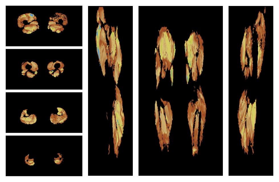 Muscle fiber tract length map based on whole leg DTI based fiber tractography.