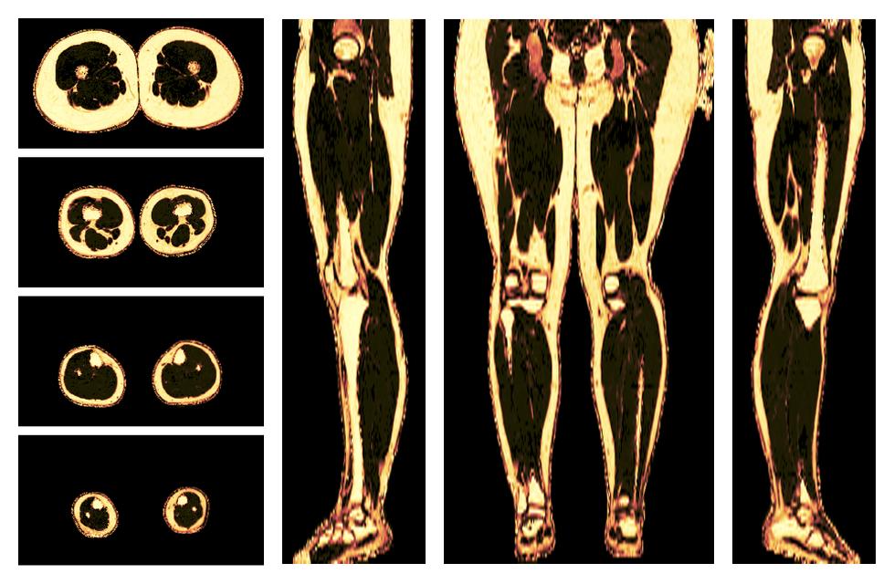 The fat fraction of the lower extremity obtained from the dixon reconstruction for muscle water fat quantification.