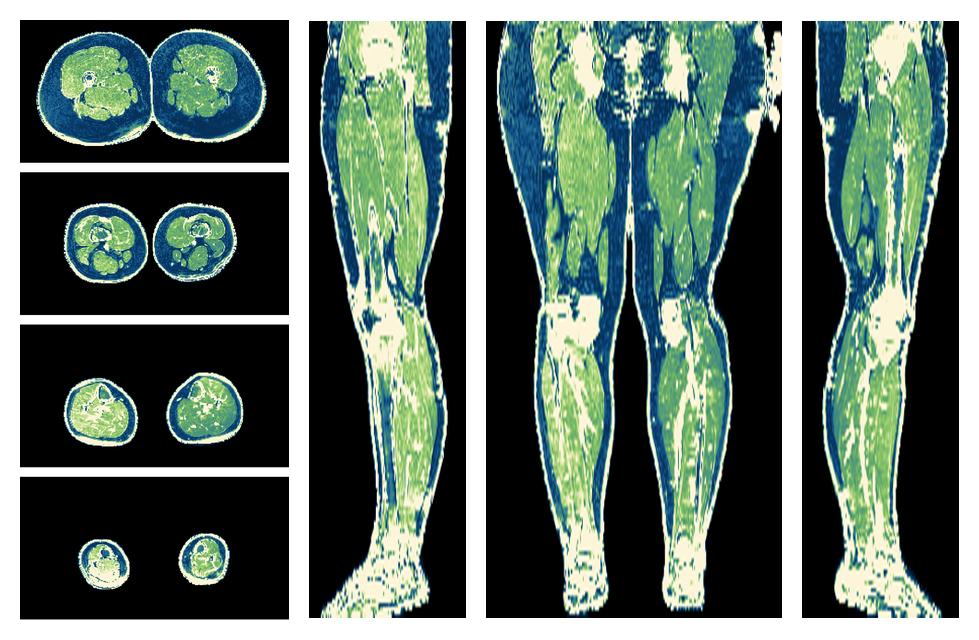 The R2 star relaxation time of the lower extremity obtained from the dixon reconstruction for muscle water fat quantification.