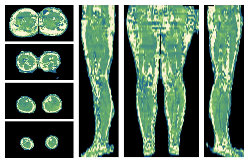 The water only T2 relaxation time of the lower extremity obtained from multi echo spin echo t2 mapping with EPG based reconstruction.