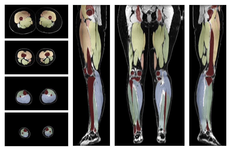 Overlay of automated muscle segmentation labels on dixon water image.