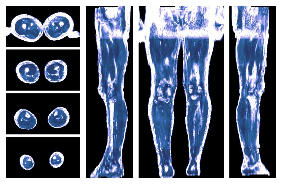 IVIM corrected whole leg muscle fractional anisotropy obtained from diffusion tensor imaging.