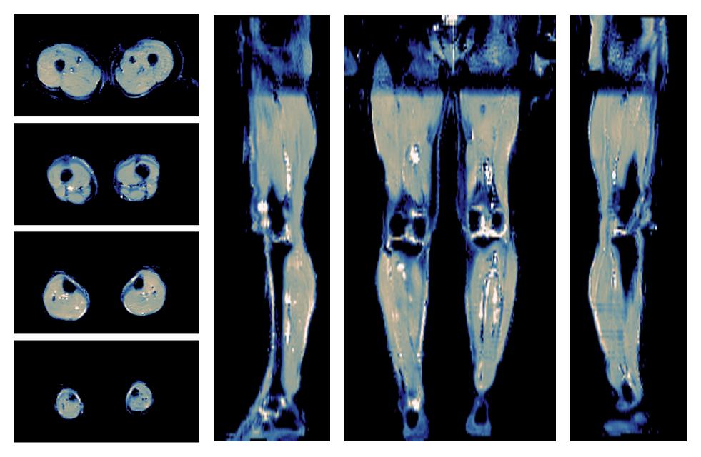 IVIM corrected whole leg muscle mean diffusivity obtained from diffusion tensor imaging.