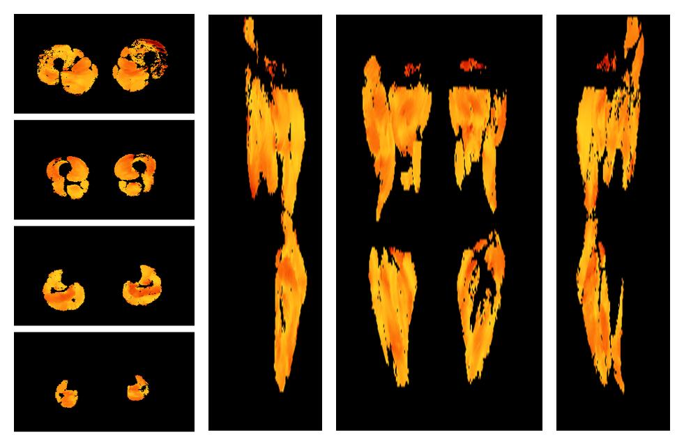 Muscle fiber tract angle map based on whole leg DTI based fiber tractography.