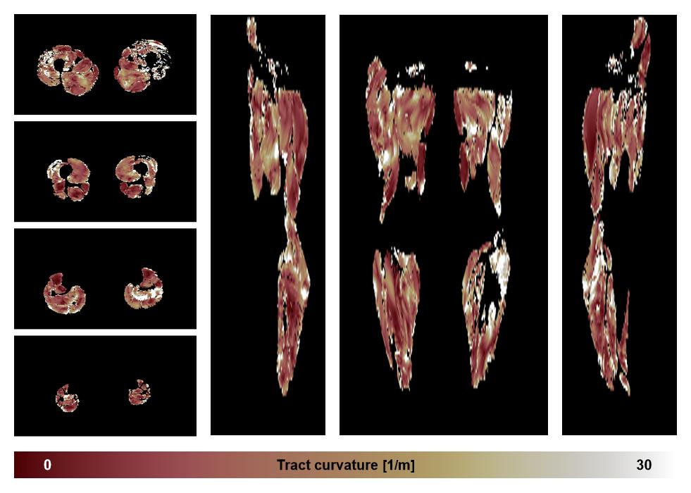 Muscle fiber tract curvature map based on whole leg DTI based fiber tractography.