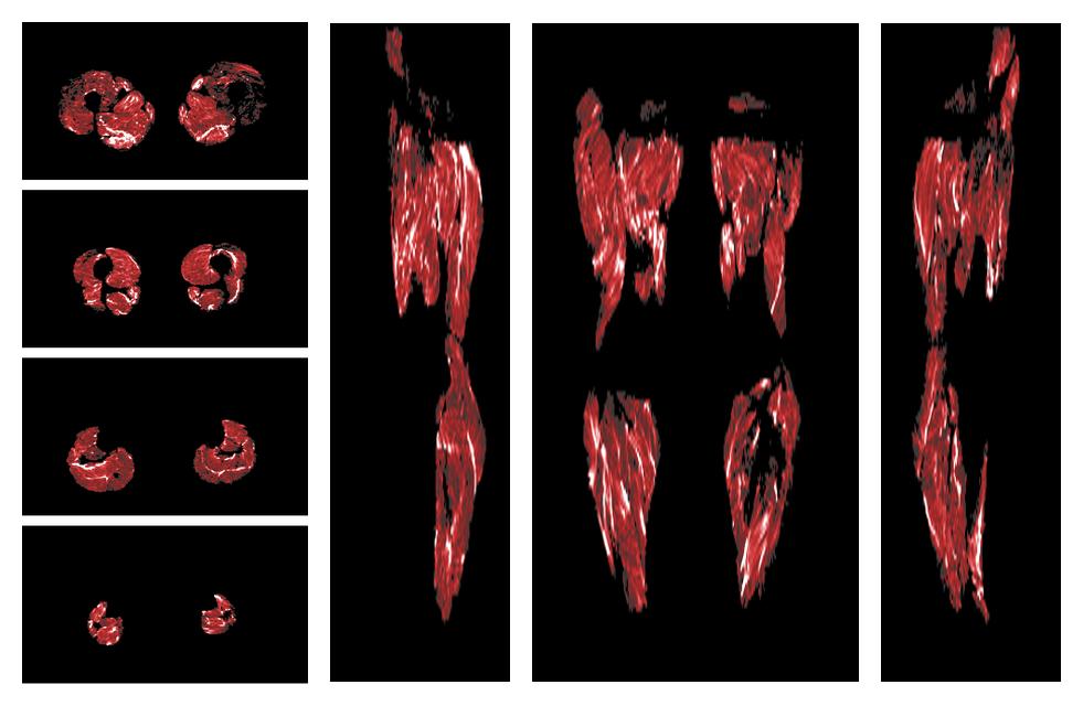 Muscle fiber tract density map based on whole leg DTI based fiber tractography.