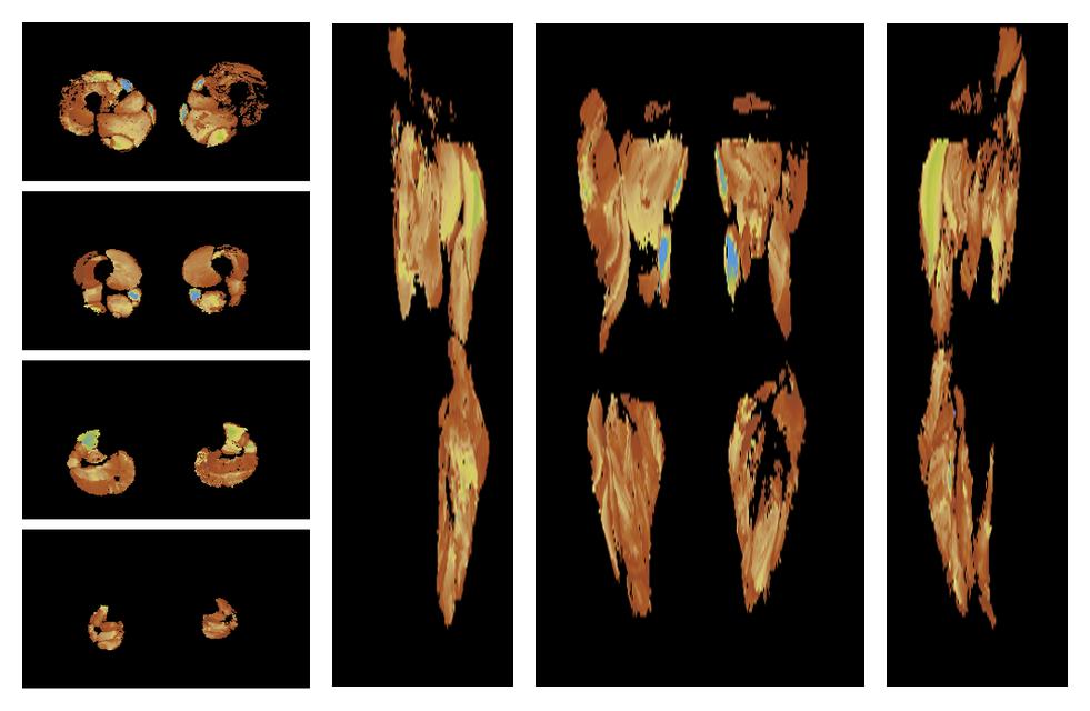 Muscle fiber tract length map based on whole leg DTI based fiber tractography.