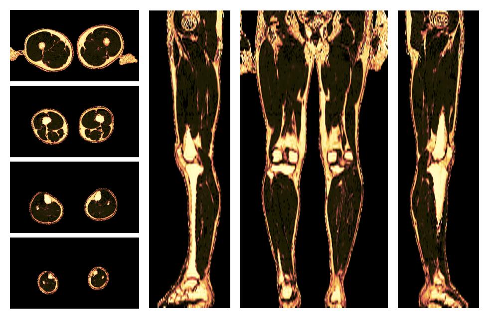 The fat fraction of the lower extremity obtained from the dixon reconstruction for muscle water fat quantification.