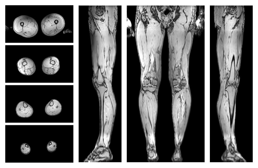 The out-phase image of the dixon reconstruction for water fat quantification.