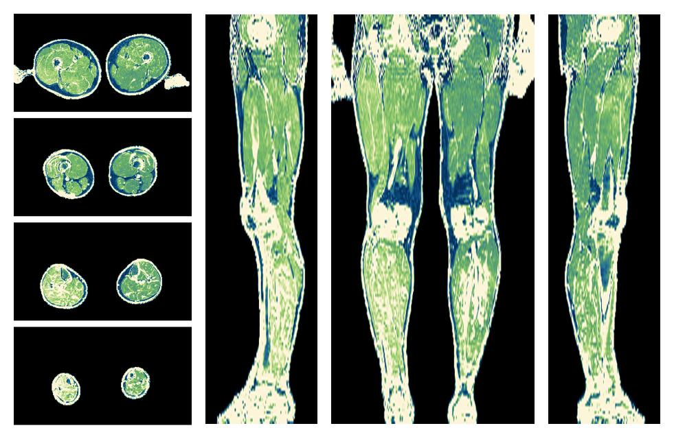 The R2 star relaxation time of the lower extremity obtained from the dixon reconstruction for muscle water fat quantification.