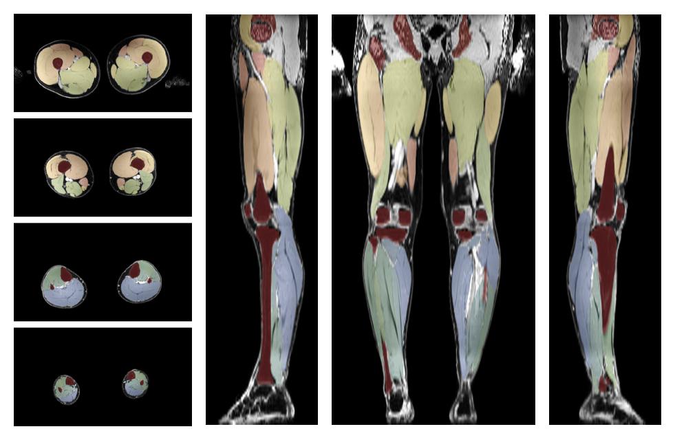 Overlay of automated muscle segmentation labels on dixon water image.