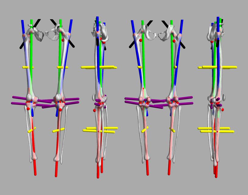 3D render of automated bone segmentation and force lines.