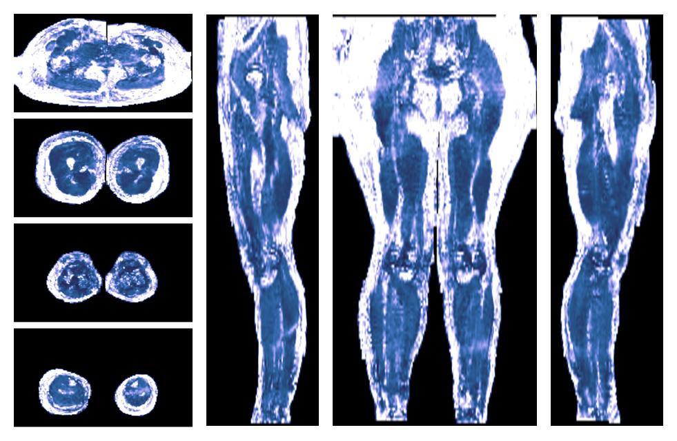 IVIM corrected whole leg muscle fractional anisotropy obtained from diffusion tensor imaging.