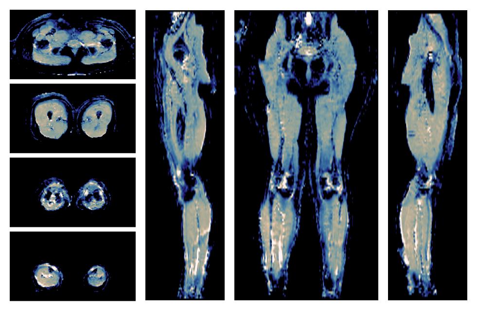 IVIM corrected whole leg muscle mean diffusivity obtained from diffusion tensor imaging.