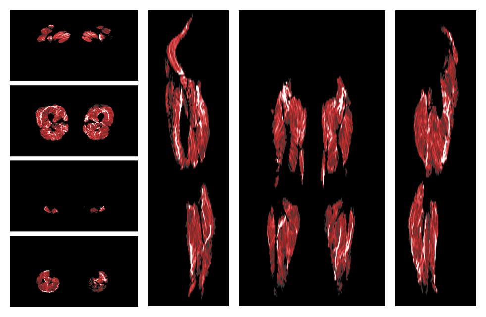 Muscle fiber tract density map based on whole leg DTI based fiber tractography.