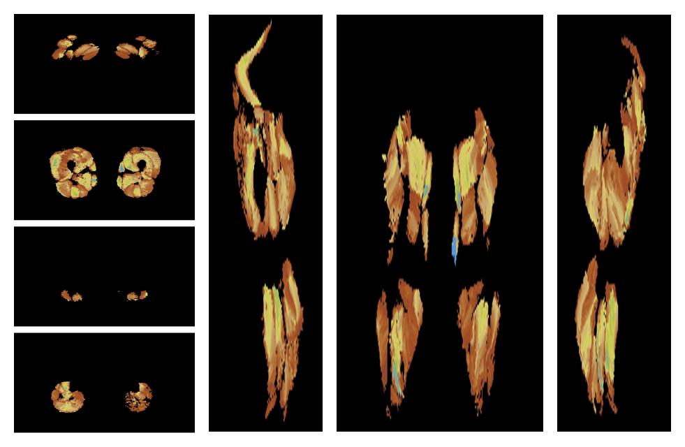 Muscle fiber tract length map based on whole leg DTI based fiber tractography.