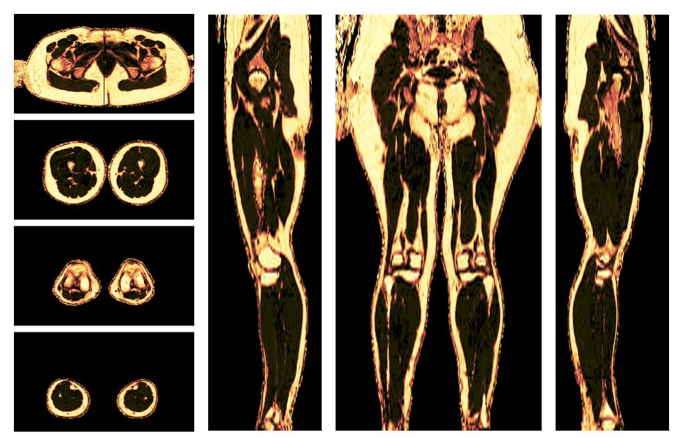 The fat fraction of the lower extremity obtained from the dixon reconstruction for muscle water fat quantification.