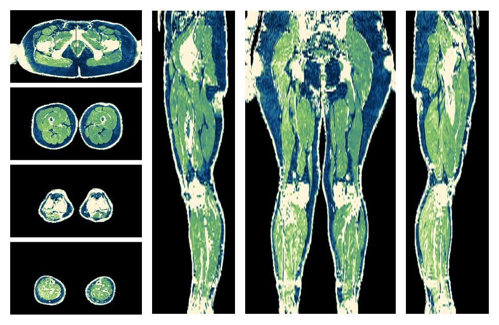 The R2 star relaxation time of the lower extremity obtained from the dixon reconstruction for muscle water fat quantification.