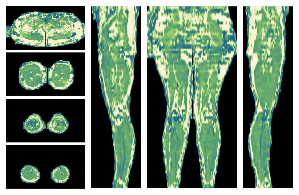 The water only T2 relaxation time of the lower extremity obtained from multi echo spin echo t2 mapping with EPG based reconstruction.