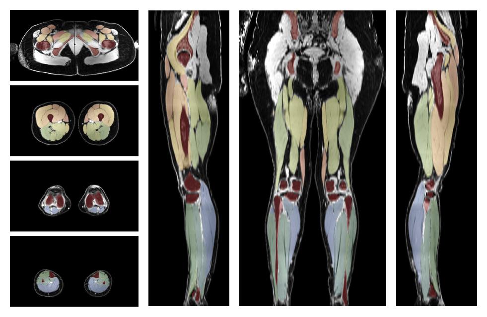 Overlay of automated muscle segmentation labels on dixon water image.