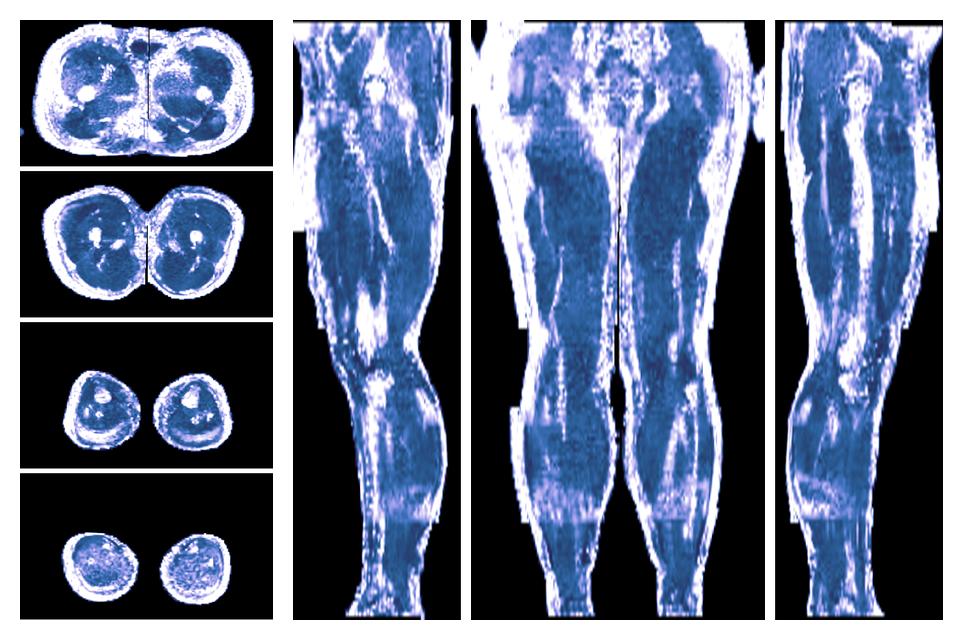 IVIM corrected whole leg muscle fractional anisotropy obtained from diffusion tensor imaging.