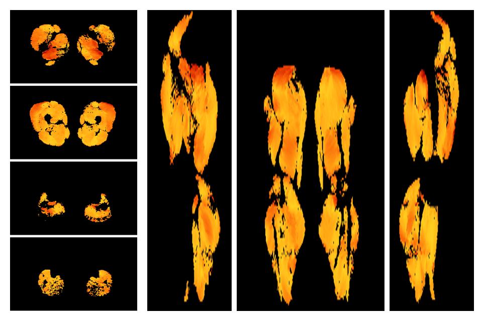 Muscle fiber tract angle map based on whole leg DTI based fiber tractography.