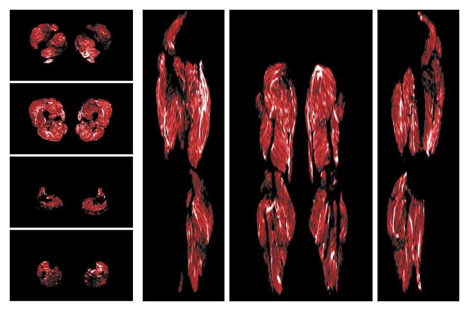 Muscle fiber tract density map based on whole leg DTI based fiber tractography.