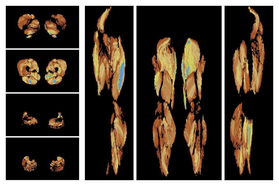 Muscle fiber tract length map based on whole leg DTI based fiber tractography.