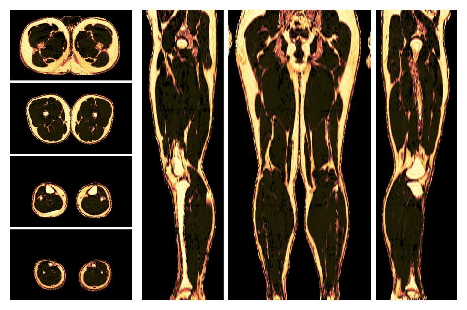 The fat fraction of the lower extremity obtained from the dixon reconstruction for muscle water fat quantification.