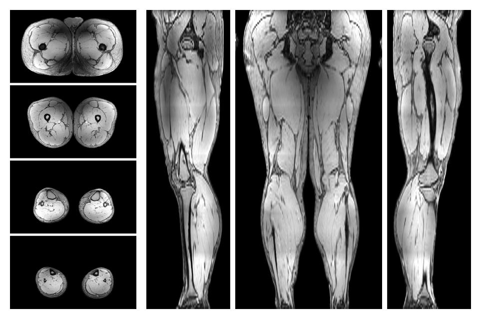 The out-phase image of the dixon reconstruction for water fat quantification.