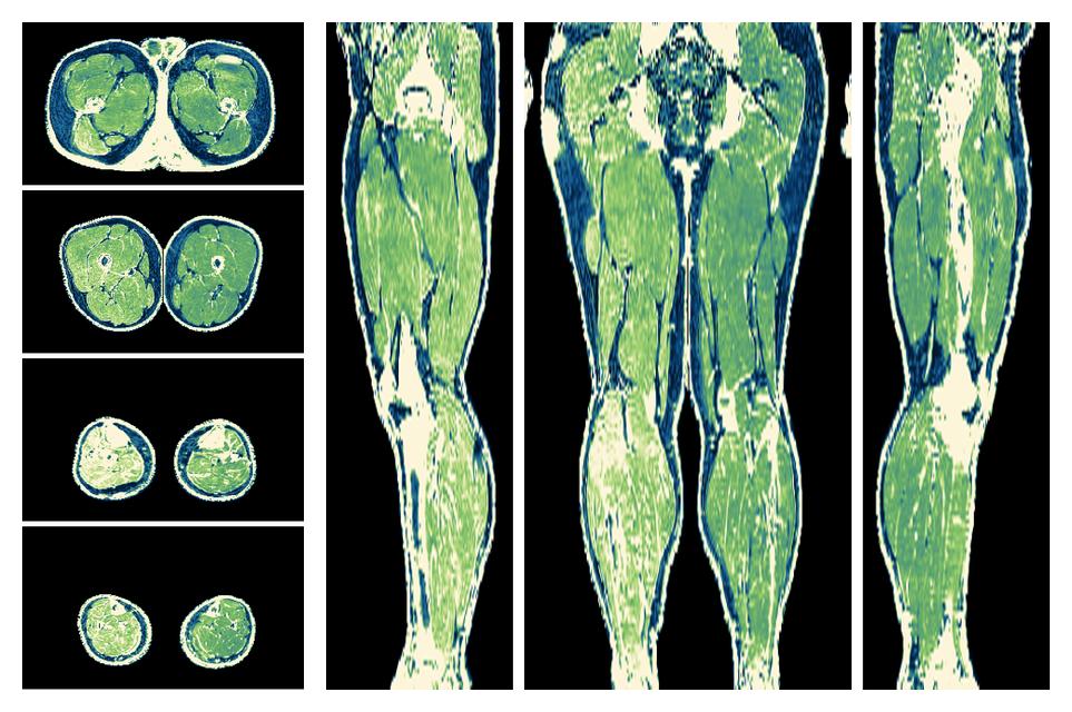 The R2 star relaxation time of the lower extremity obtained from the dixon reconstruction for muscle water fat quantification.