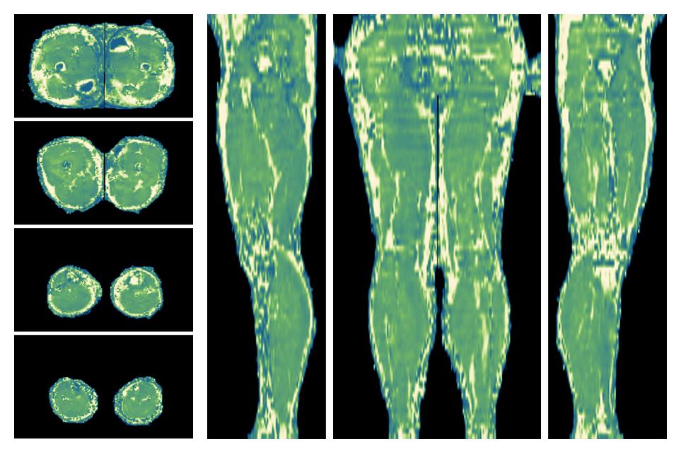 The water only T2 relaxation time of the lower extremity obtained from multi echo spin echo t2 mapping with EPG based reconstruction.